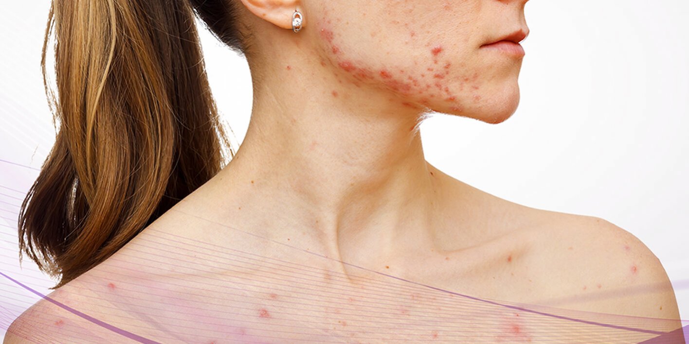 causas del acne coverac