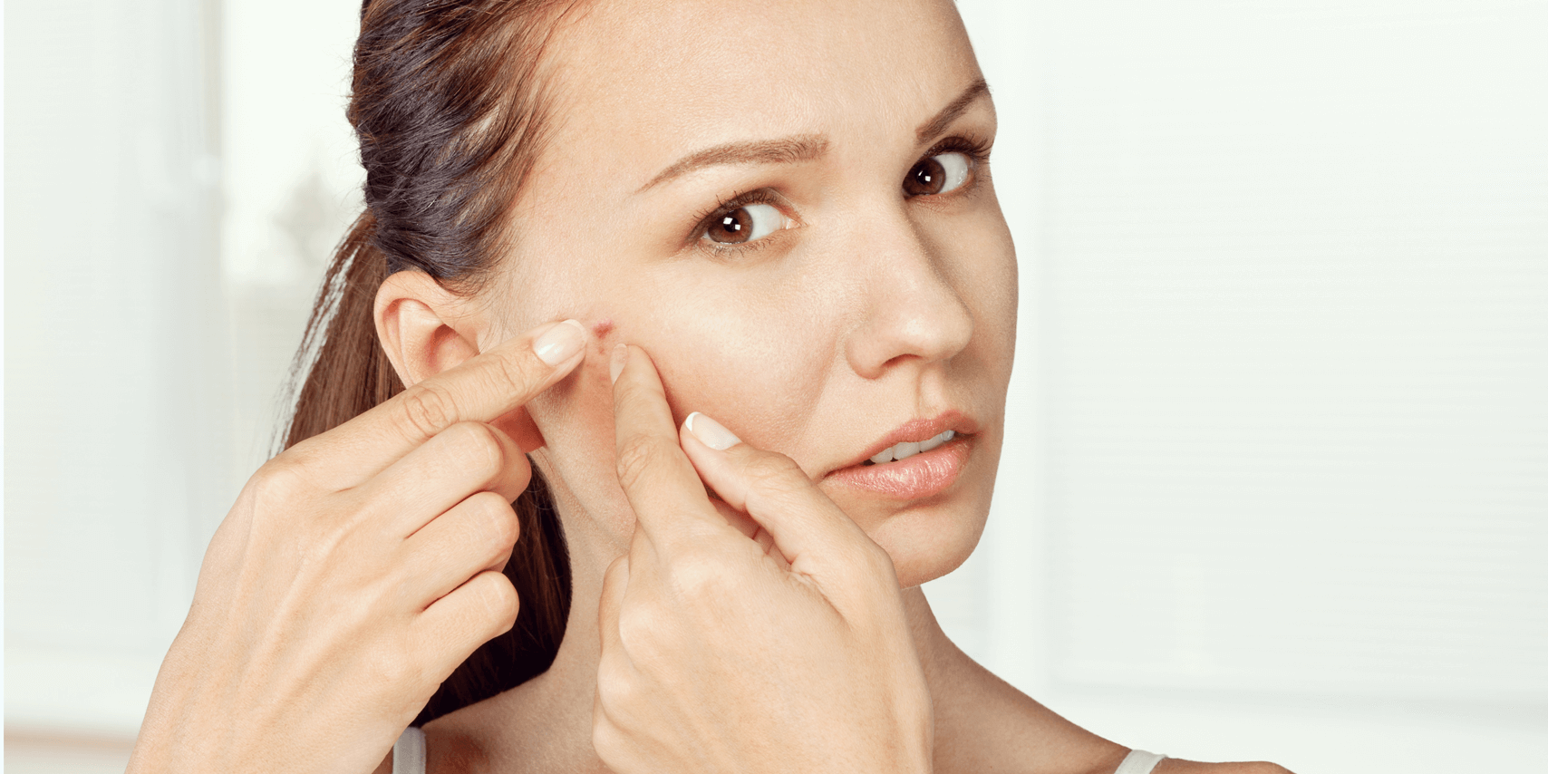 tratamientos naturales para el acne
